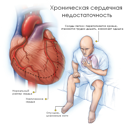 Что такое нарушение ритма сердца или аритмия?
